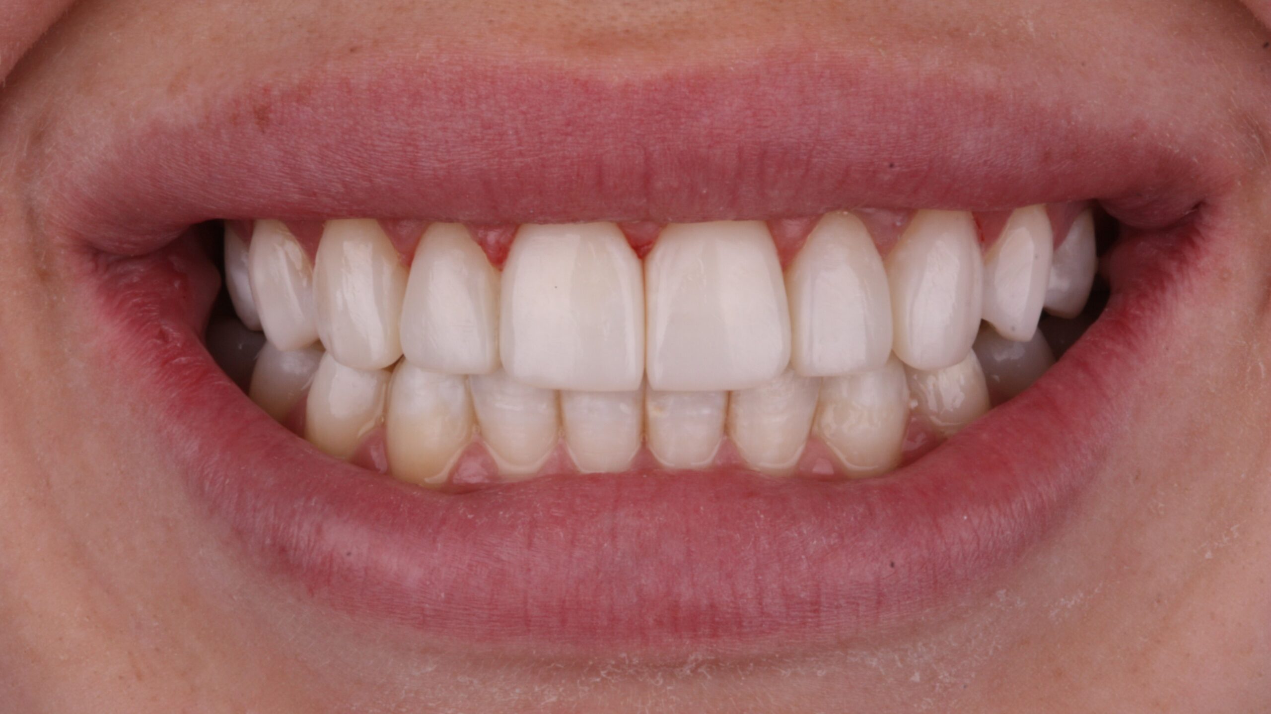 After composite bonding