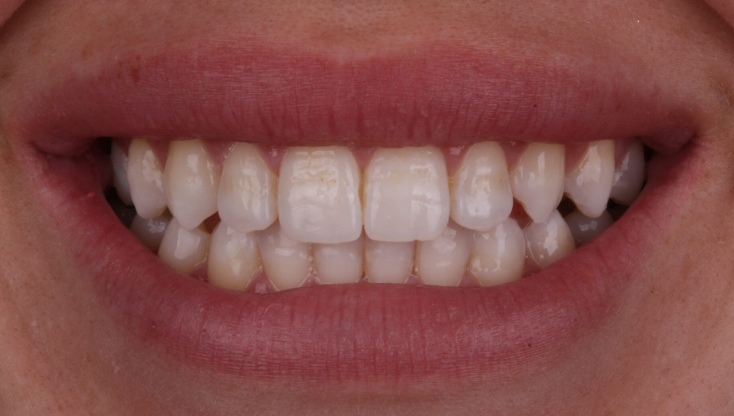 Before composite bonding
