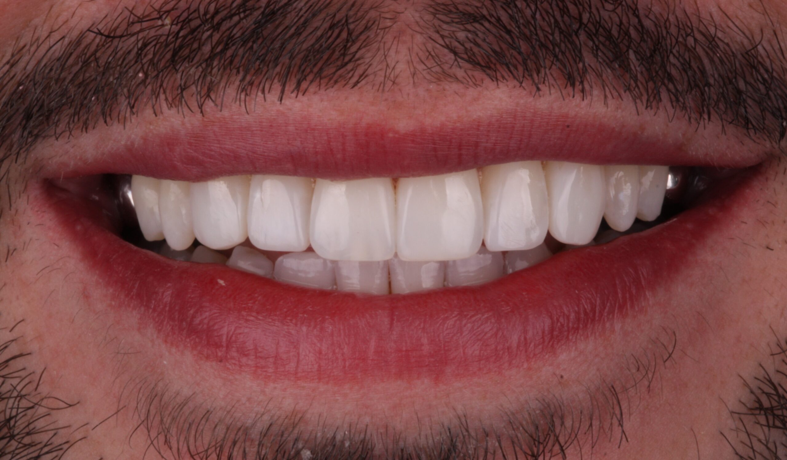 After composite bonding