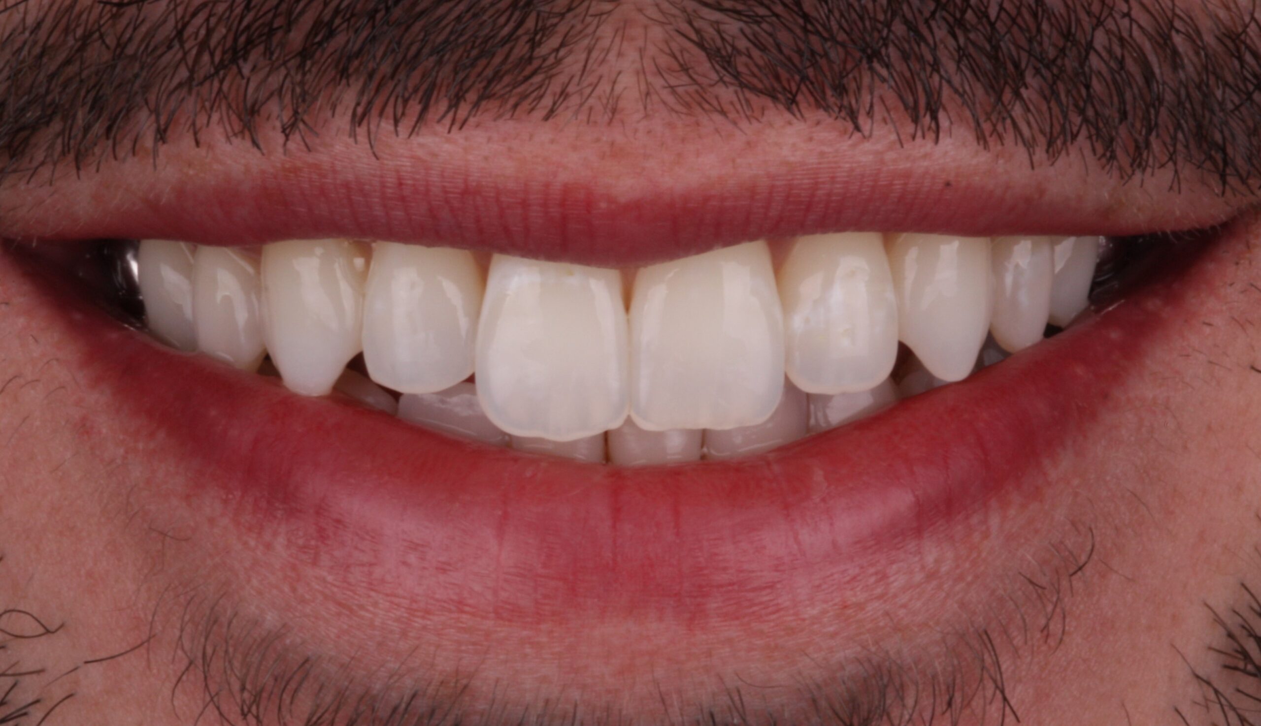 Before composite bonding