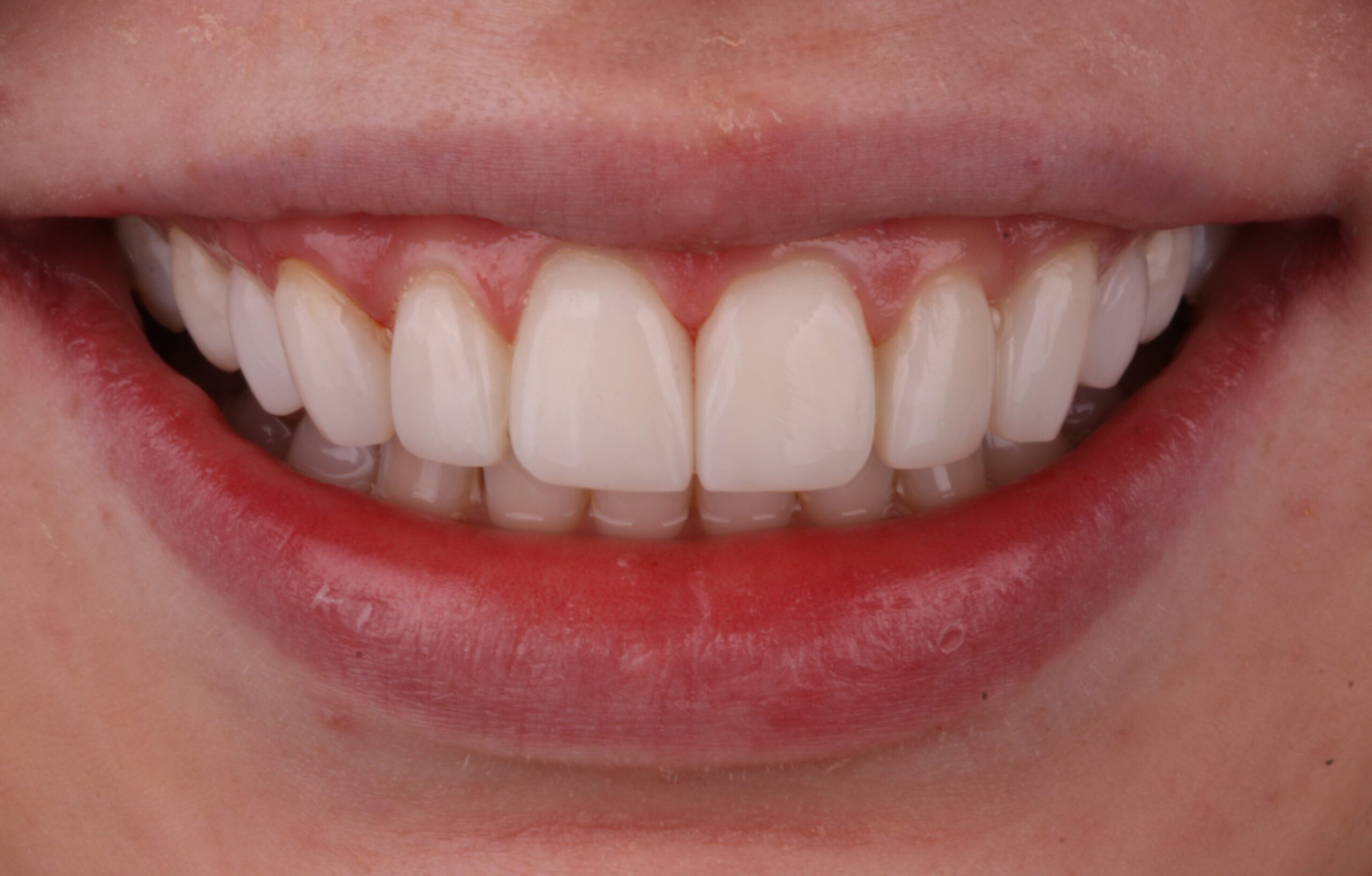 After composite bonding