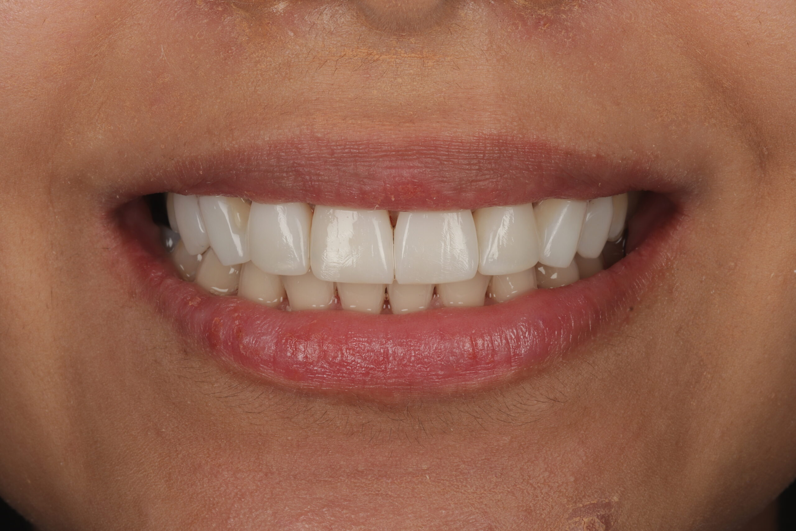 After composite bonding