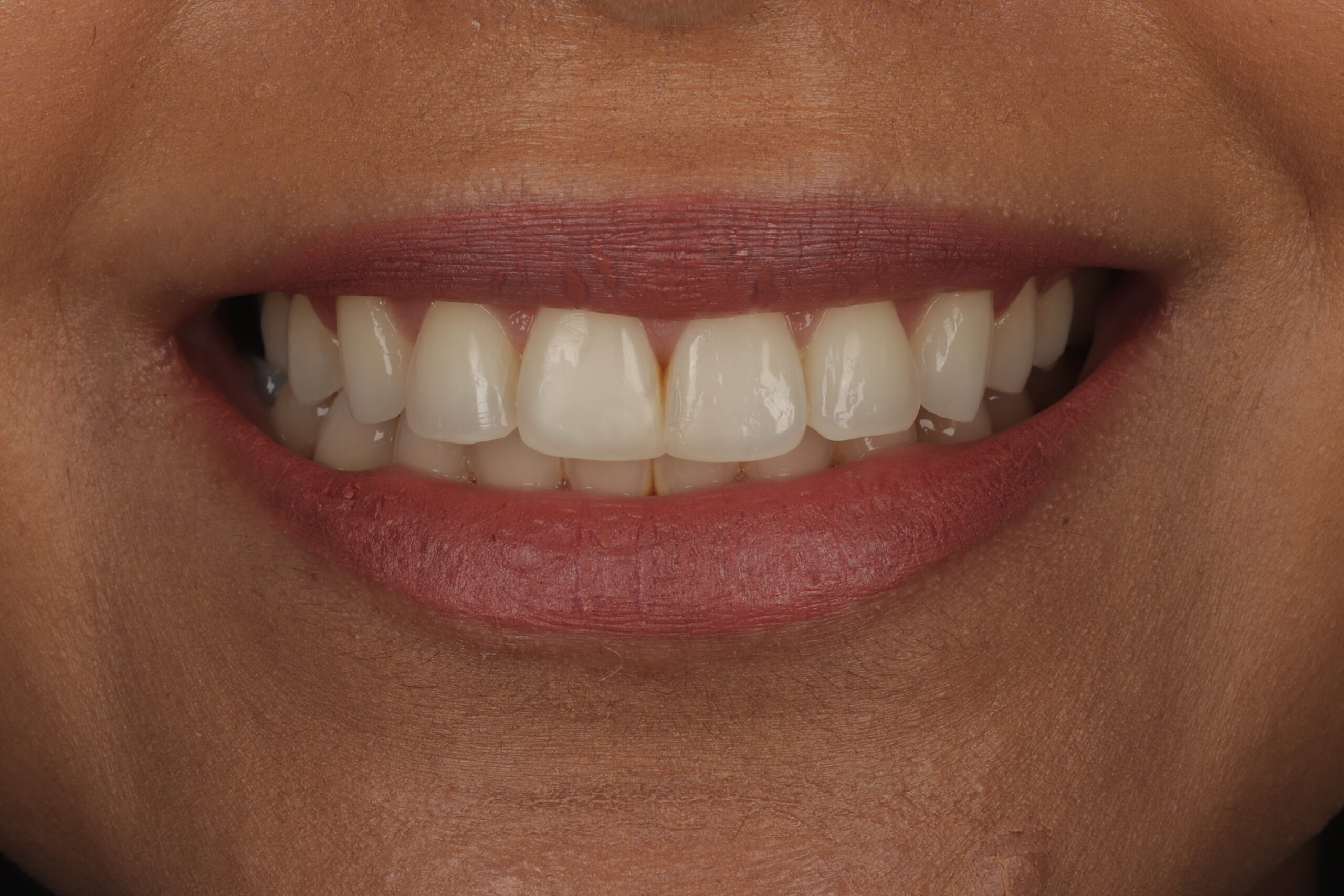 Before composite bonding