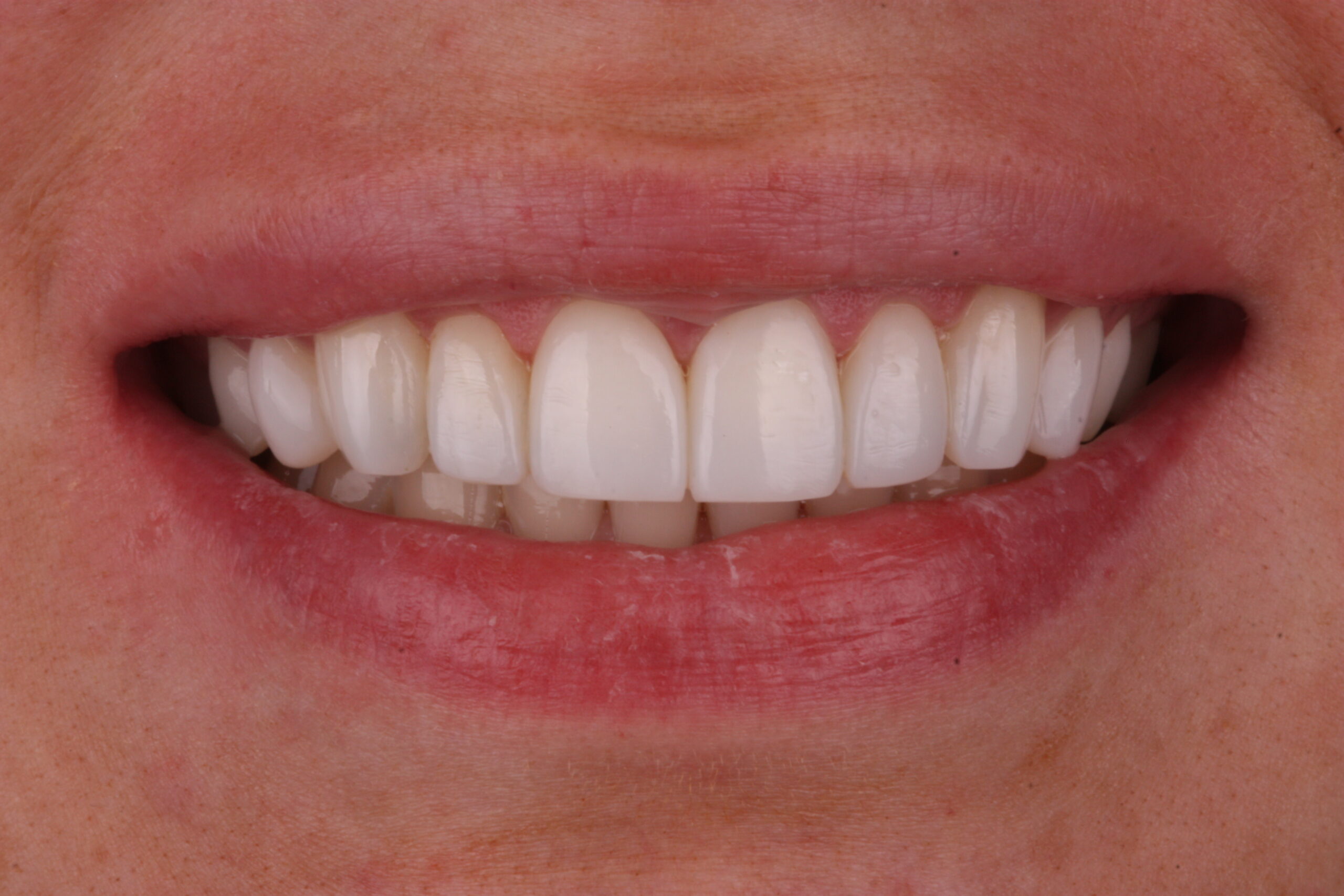 After composite bonding