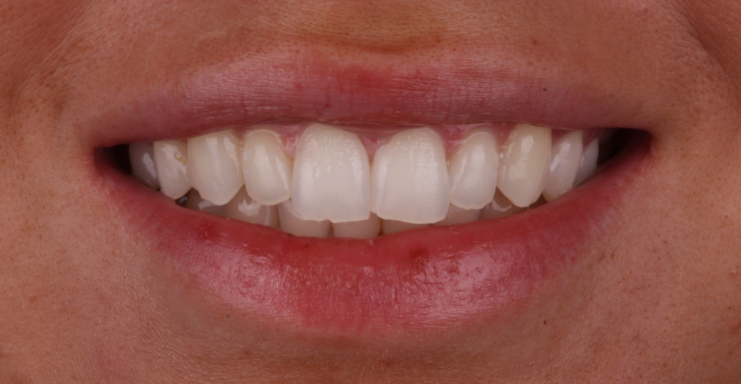 Before composite bonding