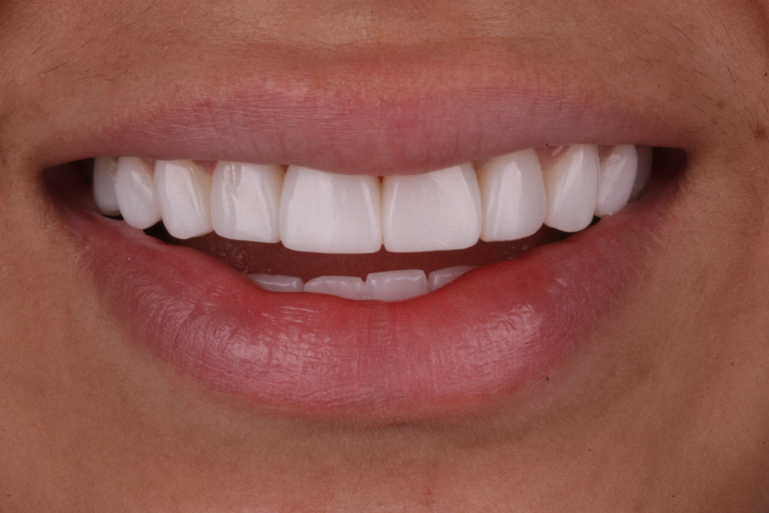After composite bonding