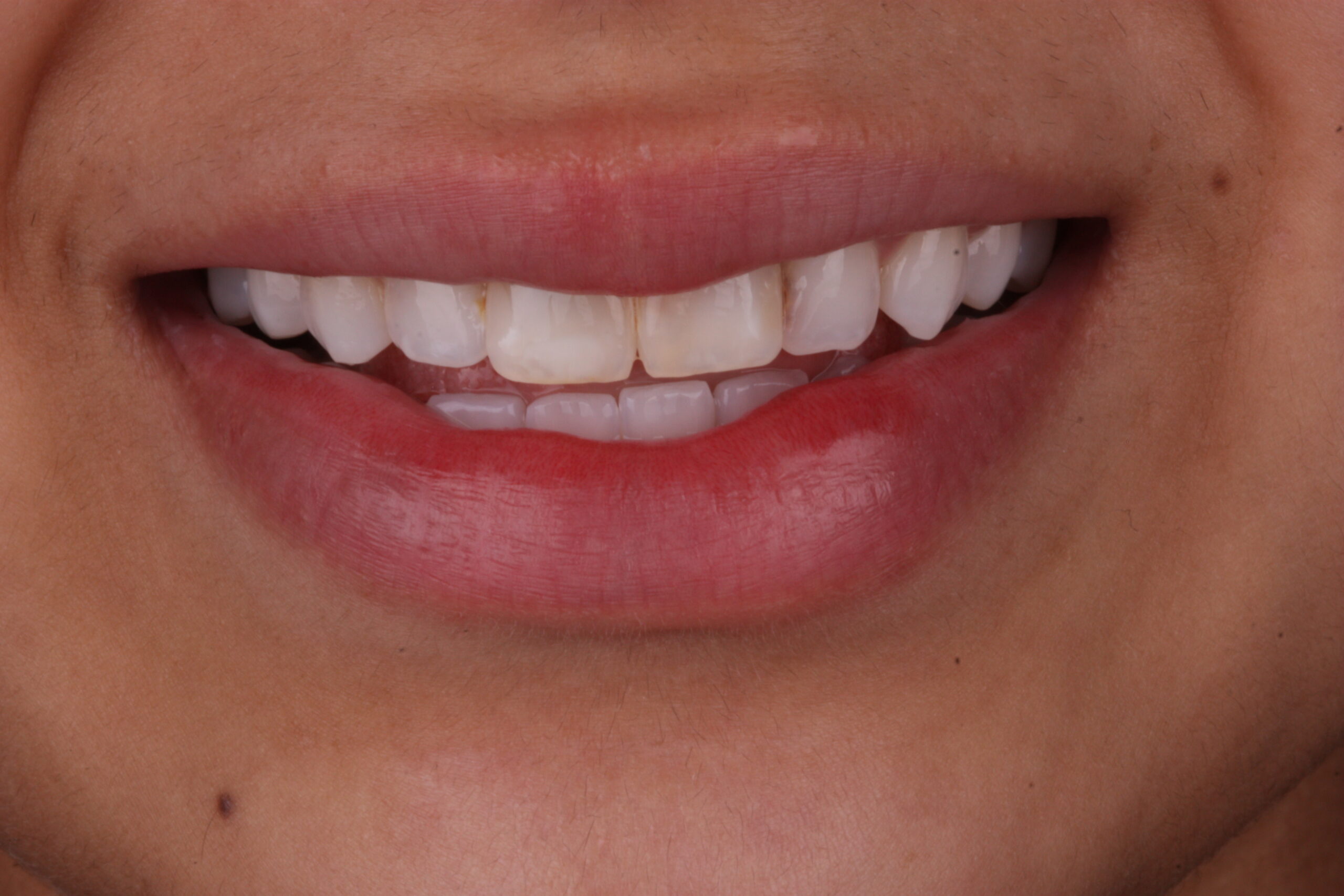 Before composite bonding